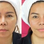 HIFU ยกกระชับผิวหย่อนคล้อย ไม่เจ็บ ไม่บวม NYCclinic รีวิวHIFU