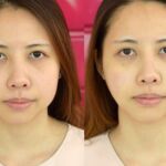 HIFU ยกกระชับผิวหย่อนคล้อย ไม่เจ็บ ไม่บวม NYCclinic รีวิวHIFU