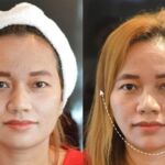 HIFU ยกกระชับผิวหย่อนคล้อย ไม่เจ็บ ไม่บวม NYCclinic รีวิวHIFU