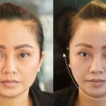 HIFU ยกกระชับผิวหย่อนคล้อย ไม่เจ็บ ไม่บวม NYCclinic รีวิวHIFU