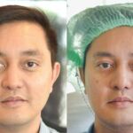 HIFU ยกกระชับผิวหย่อนคล้อย ไม่เจ็บ ไม่บวม NYCclinic รีวิวHIFU