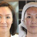 HIFU ยกกระชับผิวหย่อนคล้อย ไม่เจ็บ ไม่บวม NYCclinic รีวิวHIFU