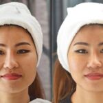 HIFU ยกกระชับผิวหย่อนคล้อย ไม่เจ็บ ไม่บวม NYCclinic รีวิวHIFU