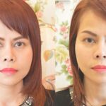 HIFU ยกกระชับผิวหย่อนคล้อย ไม่เจ็บ ไม่บวม NYCclinic รีวิวHIFU