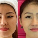 HIFU ยกกระชับผิวหย่อนคล้อย ไม่เจ็บ ไม่บวม NYCclinic รีวิวHIFU