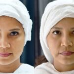 HIFU ยกกระชับผิวหย่อนคล้อย ไม่เจ็บ ไม่บวม NYCclinic รีวิวHIFU