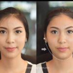 โปรโมชั่น Promotion V-SHAPE THREAD LIFTING ร้อยไหมวีเชฟ ใบหน้าเรียว ตึง ยกกระชับ ไม่เขียวช้ำ หน้าเรียว ลดริ้วรอย รีวิวV-SHAPE รีวิวร้อยไหมวีเชฟ