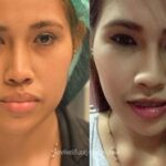 ศัลยกรรมคาง เสริมคาง ทำคาง โปรโมชั่น Promotion NYCclinic รีวิวศัลยกรรมคาง รีวิวทำคาง