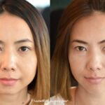 ศัลยกรรมคาง เสริมคาง ทำคาง โปรโมชั่น Promotion NYCclinic รีวิวศัลยกรรมคาง รีวิวทำคาง