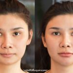 ศัลยกรรมคาง เสริมคาง ทำคาง โปรโมชั่น Promotion NYCclinic รีวิวศัลยกรรมคาง รีวิวทำคาง