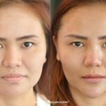 ศัลยกรรมคาง เสริมคาง ทำคาง โปรโมชั่น Promotion NYCclinic รีวิวศัลยกรรมคาง รีวิวทำคาง