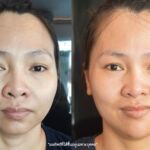 ศัลยกรรมคาง เสริมคาง ทำคาง โปรโมชั่น Promotion NYCclinic รีวิวศัลยกรรมคาง รีวิวทำคาง