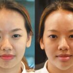 ศัลยกรรมคาง เสริมคาง ทำคาง โปรโมชั่น Promotion NYCclinic รีวิวศัลยกรรมคาง รีวิวทำคาง