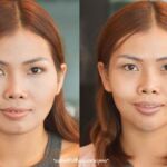 ศัลยกรรมคาง เสริมคาง ทำคาง โปรโมชั่น Promotion NYCclinic รีวิวศัลยกรรมคาง รีวิวทำคาง