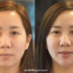 ศัลยกรรมคาง เสริมคาง ทำคาง โปรโมชั่น Promotion NYCclinic รีวิวศัลยกรรมคาง รีวิวทำคาง