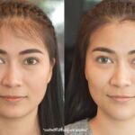 ศัลยกรรมคาง เสริมคาง ทำคาง โปรโมชั่น Promotion NYCclinic รีวิวศัลยกรรมคาง รีวิวทำคาง