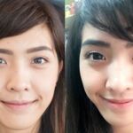ศัลยกรรมตา 2 ชั้น ทำตา 2 ชั้น รีวิวทำตา 2 ชั้น รีวิวศัลยกรรมตา 2 ชั้น NYCclinic