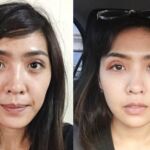 ศัลยกรรมตา 2 ชั้น ทำตา 2 ชั้น รีวิวทำตา 2 ชั้น รีวิวศัลยกรรมตา 2 ชั้น NYCclinic