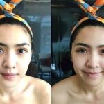 ศัลยกรรมตา 2 ชั้น ทำตา 2 ชั้น รีวิวทำตา 2 ชั้น รีวิวศัลยกรรมตา 2 ชั้น NYCclinic