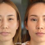 ศัลยกรรมตา 2 ชั้น ทำตา 2 ชั้น รีวิวทำตา 2 ชั้น รีวิวศัลยกรรมตา 2 ชั้น NYCclinic