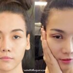 ศัลยกรรมตา 2 ชั้น ทำตา 2 ชั้น รีวิวทำตา 2 ชั้น รีวิวศัลยกรรมตา 2 ชั้น NYCclinic