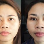 ศัลยกรรมตา 2 ชั้น ทำตา 2 ชั้น รีวิวทำตา 2 ชั้น รีวิวศัลยกรรมตา 2 ชั้น NYCclinic