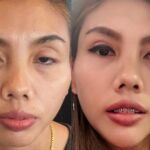 ศัลยกรรมตา 2 ชั้น ทำตา 2 ชั้น รีวิวทำตา 2 ชั้น รีวิวศัลยกรรมตา 2 ชั้น NYCclinic