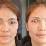 ศัลยกรรมตา 2 ชั้น ทำตา 2 ชั้น รีวิวทำตา 2 ชั้น รีวิวศัลยกรรมตา 2 ชั้น NYCclinic