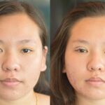 ศัลยกรรมตา 2 ชั้น ทำตา 2 ชั้น รีวิวทำตา 2 ชั้น รีวิวศัลยกรรมตา 2 ชั้น NYCclinic