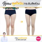 รีวิวดูดไขมัน-หมอเป๊ก-NYC Clinic-49