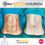 รีวิวดูดไขมัน-หมอเป๊ก-NYC Clinic-40