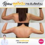 รีวิวดูดไขมัน-หมอเป๊ก-NYC Clinic-38
