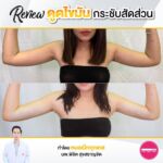 รีวิวดูดไขมัน-หมอเป๊ก-NYC Clinic-37