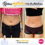 รีวิวดูดไขมัน-หมอเป๊ก-NYC Clinic-35