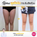 รีวิวดูดไขมัน-หมอเป๊ก-NYC Clinic-34