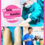 รีวิวดูดไขมัน-หมอเป๊ก-NYC Clinic-32