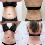 รีวิวดูดไขมัน-หมอเป๊ก-NYC Clinic-31