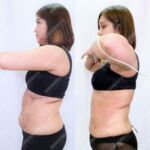 รีวิวดูดไขมัน-หมอเป๊ก-NYC Clinic-29