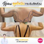 รีวิวดูดไขมัน-หมอเป๊ก-NYC Clinic-47
