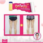 รีวิวดูดไขมัน-หมอเป๊ก-NYC Clinic-20