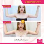 รีวิวดูดไขมัน-หมอเป๊ก-NYC Clinic-19