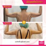 รีวิวดูดไขมัน-หมอเป๊ก-NYC Clinic-18