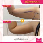 รีวิวดูดไขมัน-หมอเป๊ก-NYC Clinic-17