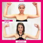 รีวิวดูดไขมัน-หมอเป๊ก-NYC Clinic-16