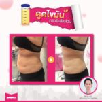 รีวิวดูดไขมัน-หมอเป๊ก-NYC Clinic-15