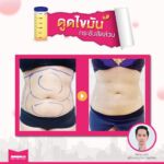 รีวิวดูดไขมัน-หมอเป๊ก-NYC Clinic-14