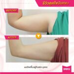 รีวิวดูดไขมัน-หมอเป๊ก-NYC Clinic-14