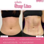 รีวิวดูดไขมัน-หมอเป๊ก-NYC Clinic-13