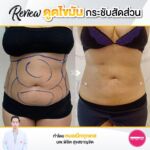 รีวิวดูดไขมัน-หมอเป๊ก-NYC Clinic-46