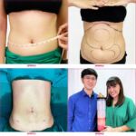 รีวิวดูดไขมัน-หมอเป๊ก-NYC Clinic-11